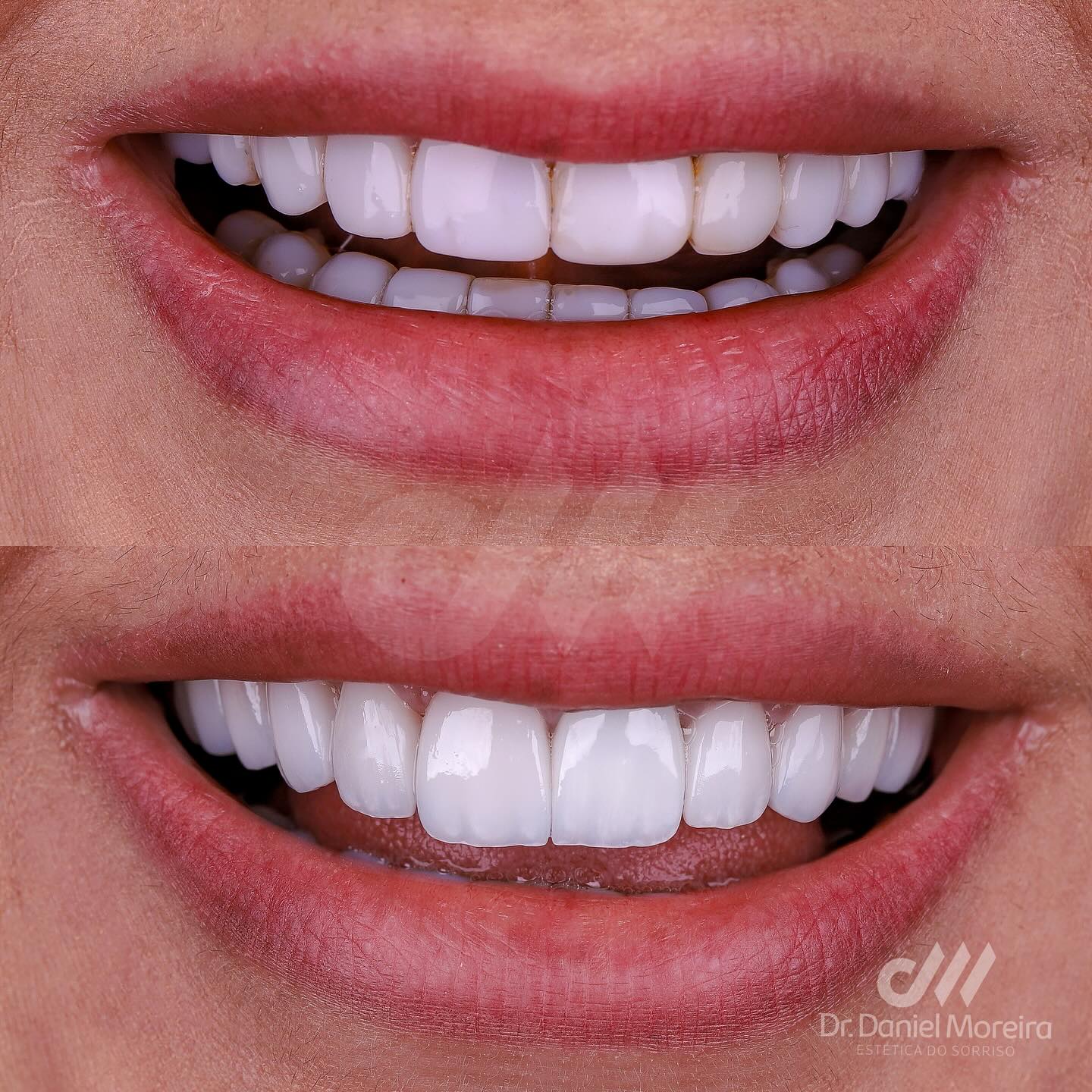 Antes e depois - Odontologia estética Maceió