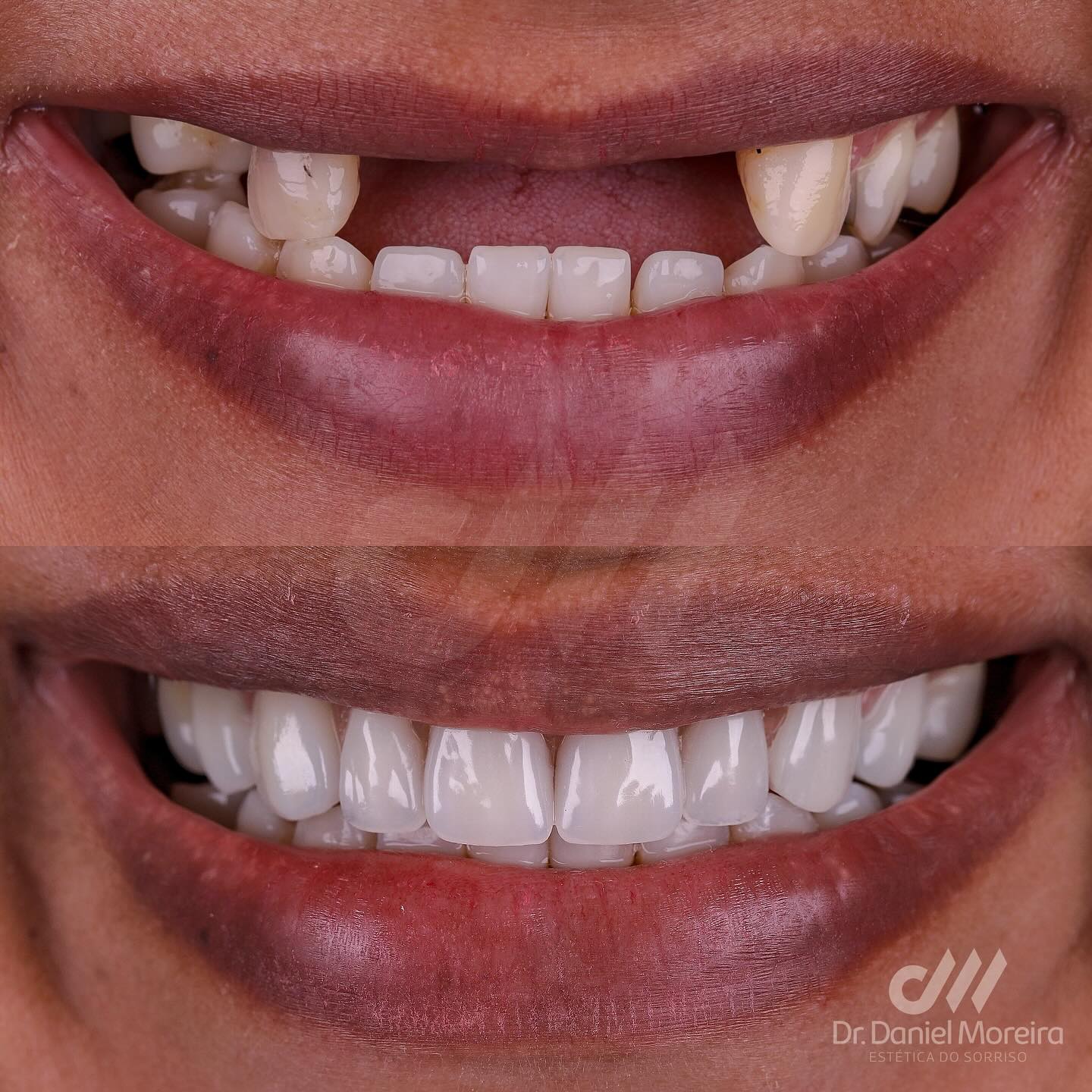 Antes e depois - Tratamento odontológico Dr. Daniel Moreira