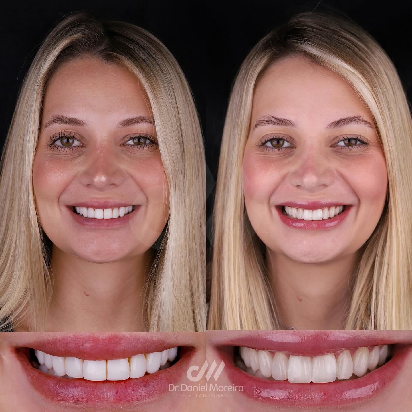 Antes e depois - Prótese dentária Maceió
