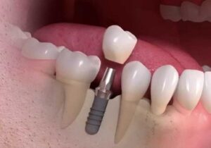 Implante Dentário em Maceió